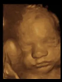 Ultraschallbild eines ungeborenen Babys, auf dem das Gesicht deutlich zu erkennen ist. Der Ausdruck ist ruhig, mit geschlossenen Augen und leicht geschlossenem Mund. Das Bild zeigt die Details des Gesichts in warmen, goldenen Tönen.