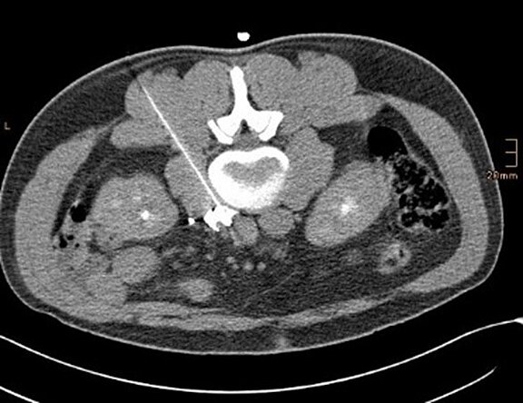 CT-Querschnitt des Abdomens: Eine helle Punktions- bzw. Biopsienadel verläuft von links schräg nach innen und zielt auf eine Struktur im Nierenbereich. Darstellung eines CT‑gestützten Eingriffs.