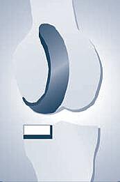 Schematische Illustration eines Kniegelenks: Oberschenkelknochen oben, Schienbein unten. Zwischen den Knochen ist ein dunkel markierter, halbmondförmiger Meniskus hervorgehoben, der die Gelenkfläche polstert.