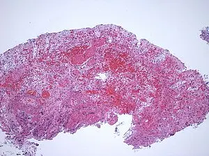 Eine mikroskopische Aufnahme eines Gewebes, hauptsächlich in verschiedenen Rottönen. Die Struktur zeigt eine unregelmäßige, geclusterte Anordnung von Zellen, die zur Analyse histologischer Merkmale verwendet werden kann.