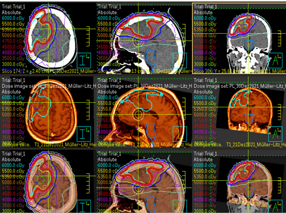 Neun Panels mit Gehirn-CT/MRT zeigen farbige Iso-Dosislinien. Ein markiertes Areal in mehreren Ebenen kennzeichnet das Bestrahlungsziel (Tumor). Die Konturen und Skalen veranschaulichen geplante Strahlendosen zur Radiotherapie und deren Verteilung im Gehirngewebe.