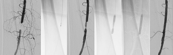Vierteilige Röntgen-Angiografie: links stark verengte Arterie mit Umgehungsgefäßen, danach Drahtführung durch die Engstelle, anschließend Ballonaufdehnung, rechts als Ergebnis eine frei und gleichmäßig durchströmte Arterie. Die Bildreihe zeigt eine endovaskuläre Behandlung zur Wiederherstellung des Blutflusses.
