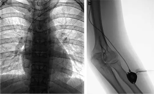 Zwei Röntgenaufnahmen: links der Brustkorb mit Rippen und zentralem Herz-Lungen-Schatten. Rechts ein seitlicher Ellenbogen/Unterarm mit eingeführtem Katheter; ein aufgeblasener Ballon ist in einem Gefäß sichtbar. Darstellung einer Katheterisierung über den Armzugang.