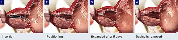 Vier Bilder zeigen eine endoskopische Behandlung einer Engstelle am Übergang von Speiseröhre zum Magen: Einführen eines zusammengefalteten Stents, exakte Positionierung in der Stenose, selbstständige Erweiterung nach fünf Tagen, anschließende Entfernung des Geräts – die Öffnung bleibt geweitet.