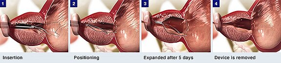 Vier Bilder zeigen eine endoskopische Behandlung einer Engstelle am Übergang von Speiseröhre zum Magen: Einführen eines zusammengefalteten Stents, exakte Positionierung in der Stenose, selbstständige Erweiterung nach fünf Tagen, anschließende Entfernung des Geräts – die Öffnung bleibt geweitet.