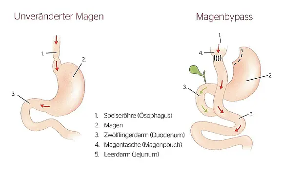 Grafik vergleicht unveränderten Magen mit Magenbypass: links normaler Verdauungsweg vom Ösophagus in den Magen und Zwölffingerdarm. Rechts kleiner Magentasche; Nahrung umgeht großen Teil des Magens und Zwölffingerdarms und fließt direkt in den Dünndarm (Jejunum). Pfeile zeigen Flussrichtung.
