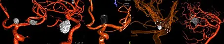 Die Abbildung zeigt mehrere Darstellungen von Blutgefäßen in einem medizinischen Kontext. Rot und orangefarbene Strukturen symbolisieren Blutgefäße, während graue, kugelförmige Objekte darauf hinweisen, dass einige Bereiche möglicherweise verdickt oder verändert sind.