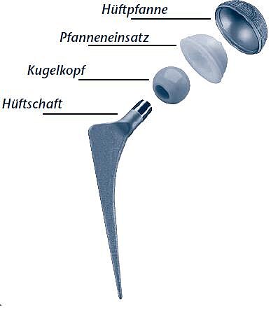 Explosionsdarstellung einer Hüftprothese: Ein langer Hüftschaft trägt einen runden Kugelkopf, der in einen Pfanneneinsatz passt; dieser sitzt in der äußeren Hüftpfanne. Die vier Bauteile ergeben zusammen ein künstliches Hüftgelenk.