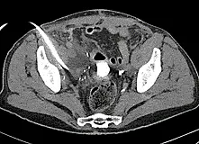 CT-Querschnitt des Beckens mit eingeführter Drainagenadel von links, die auf eine abgekapselte Flüssigkeitsansammlung im kleinen Becken zielt; Knochen des Beckens und Weichteile sichtbar.