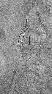 Röntgenbild des Bauchs mit einem implantierten Vena-cava-Filter. Das drahtartige, schirmförmige Implantat sitzt in der unteren Hohlvene und dient dem Auffangen von Blutgerinnseln.