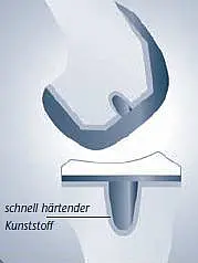 Schema: Ein hakenförmiges Teil greift in eine Gegenform; die Verbindung wird durch schnell härtenden Kunststoff hergestellt und fixiert.