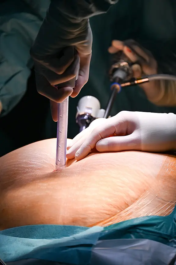 Nahaufnahme eines Operationsfelds am Bauch: Hände in sterilen Handschuhen markieren und messen den Hautschnitt mit einem Lineal und führen laparoskopische Instrumente durch Trokare ein.