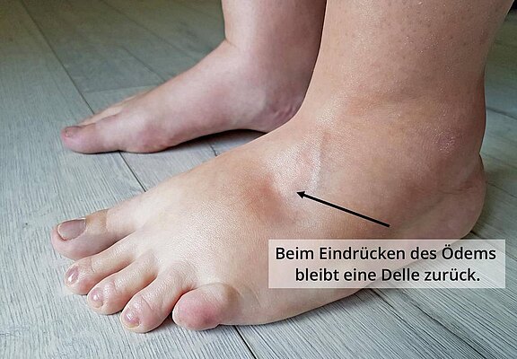 Foto eines geschwollenen Fußes mit Knöchelödem. Ein Pfeil zeigt auf eine vertiefte Spur nach Fingerdruck: typisches Pitting-Ödem, bei dem eine Delle bestehen bleibt.