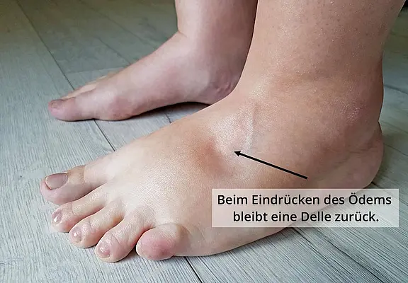 Foto eines geschwollenen Fußes mit Knöchelödem. Ein Pfeil zeigt auf eine vertiefte Spur nach Fingerdruck: typisches Pitting-Ödem, bei dem eine Delle bestehen bleibt.