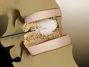 Eine schematische Darstellung eines Gelenks, bei dem ein medizinisches Instrument verwendet wird, um eine Behandlung durchzuführen. Das Bild zeigt die Innenseite des Gelenks mit einer bearbeiteten Knochenschicht und einem Material, das in das Gelenk eingeführt wird.