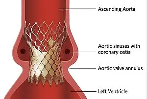 Diagramm des menschlichen Herzens, das die aufsteigende Aorta, die aortalen Sinus mit den Koronaröffnungen, den Aortenklappenanulus und den linken Ventrikel darstellt. Es zeigt die positionelle Beziehung dieser Strukturen zueinander.