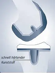 Schematische Querschnittszeichnung einer Verbindung: Ein Haken- bzw. Klemmprofil rastet in ein pilzförmiges Gegenstück ein. Das untere Teil wird durch schnell härtenden Kunststoff umhüllt und fixiert.