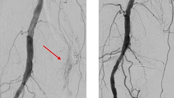 Zwei angiografische Aufnahmen einer Beinarterie: Links zeigt die Kontrastmittelaufnahme eine Leckage/Blutung (roter Pfeil). Rechts nach Behandlung: Gefäß ohne Austritt, Fluss regelhaft. Bild demonstriert erfolgreiche Embolisation/Behandlung einer Gefäßblutung.