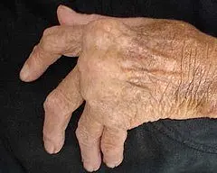 Hände einer Patientin mit langjähriger Rheumatoider Arthritis Nahaufnahme einer älteren Hand mit sichtbaren Falten und überkreuzten, leicht gekrümmten Fingern vor dunklem Hintergrund.