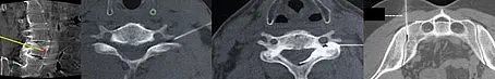 Die Abbildung zeigt verschiedene Schnittbilder von CT-Scans, die Wirbelsäulenstrukturen und möglicherweise diagnostische Befunde veranschaulichen. Die Bildfolgen bieten einen Einblick in verschiedene Ansichten der Wirbelsäule zur medizinischen Analyse.