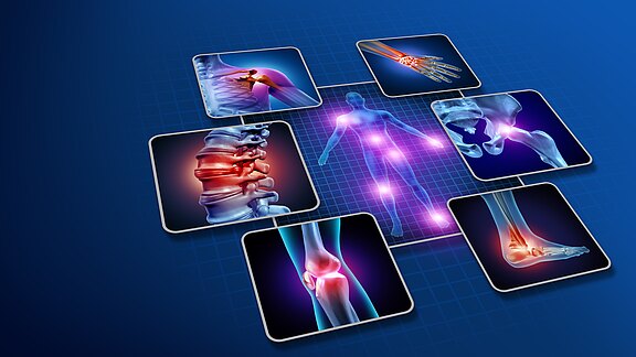 Infografik eines menschlichen Körpers mit leuchtenden Schmerzpunkten. Ringsum Detailbilder von Schulter, Handgelenk, Wirbelsäule, Hüfte, Knie und Sprunggelenk, jeweils entzündlich markiert. Visualisierung von Gelenk- und Rückenbeschwerden im muskuloskelettalen System.