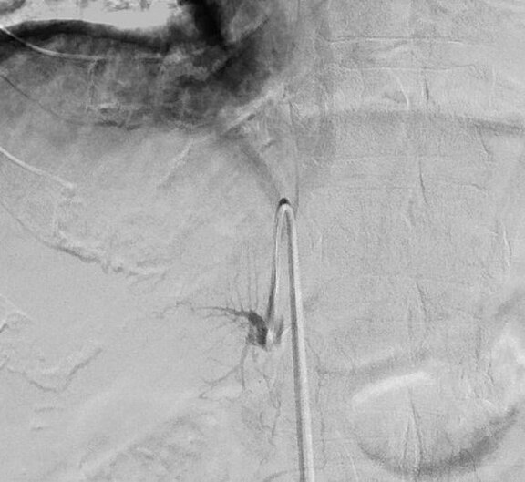 Schwarz-weiße Angiografieaufnahme: Ein dünner Katheter liegt in einem Blutgefäß. Eingespritztes Kontrastmittel macht den Gefäßverlauf und eine Abzweigung sichtbar. Fokus auf die Darstellung der Gefäße während eines minimal-invasiven Eingriffs.