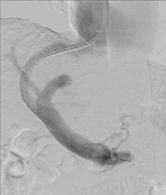 Das Bild zeigt eine medizinische Bildgebung, auf der ein Schlauch oder Katheter sichtbar ist, der sich durch ein anatomisches Gebiet bewegt. Die Darstellung ist in Graustufen gehalten, was die verschiedenen Strukturen hervorhebt.