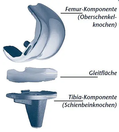 Darstellung einer Knieendoprothese: obere Femur-Komponente, mittige Gleitfläche, untere Tibia-Komponente. Zeigt, wie die drei Teile zusammen ein künstliches Kniegelenk bilden.