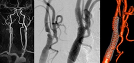 Die Abbildung zeigt drei verschiedene medizinische Bildgebungsverfahren von Blutgefäßen. Links ist eine digitale Subtraktionsangiographie zu sehen, in der Mitte ein Röntgenbild und rechts eine farbige Darstellung von Gefäßen, die unterschiedliche Blutflüsse und mögliche Blockaden anzeigt.