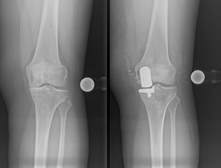 Zwei nebeneinander stehende Röntgenaufnahmen eines Knies: links normales Gelenk, rechts dasselbe Knie mit eingesetzter Metallplatte und Schrauben nahe dem Schienbeinkopf; Vergleich vor und nach operativer Versorgung.