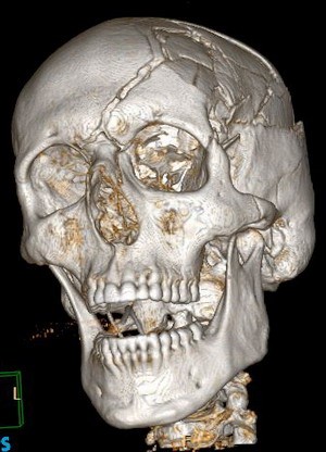 Eine 3D-Darstellung eines menschlichen Schädels, die Details wie Augenhöhlen, Kiefer und Zahnstruktur zeigt. Der Schädel weist einige Brüche auf, was auf ein Trauma hinweisen könnte.