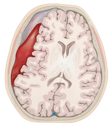 Die Abbildung zeigt einen Querschnitt des menschlichen Gehirns. Die verschiedenen Bereiche sind farblich hervorgehoben, wobei ein Teil in Rot dargestellt ist. Dies verdeutlicht die unterschiedlichen Regionen und Strukturen des Gehirns, einschließlich der Muster der Gehirnwindungen.